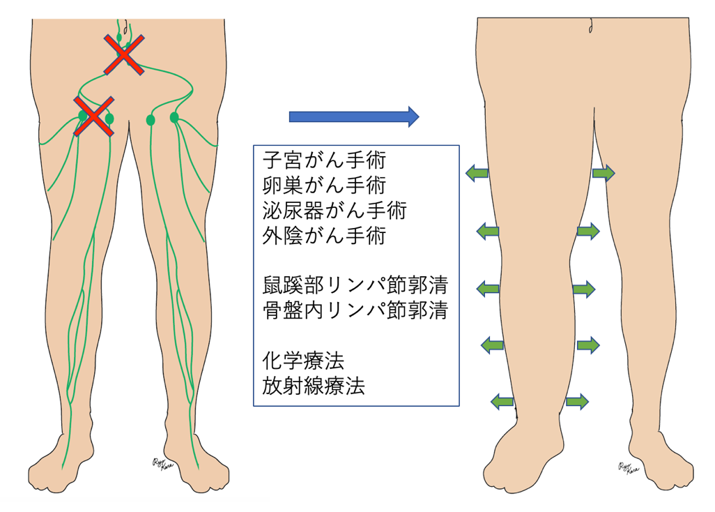 足 の 甲 リンパ 浮腫